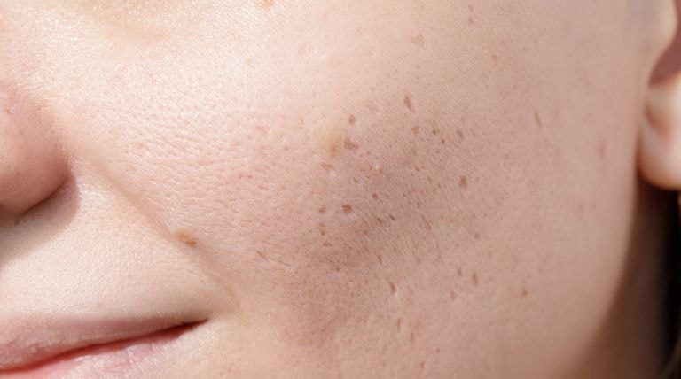 foco no rosto feminino com cicatrizes pós acne severa