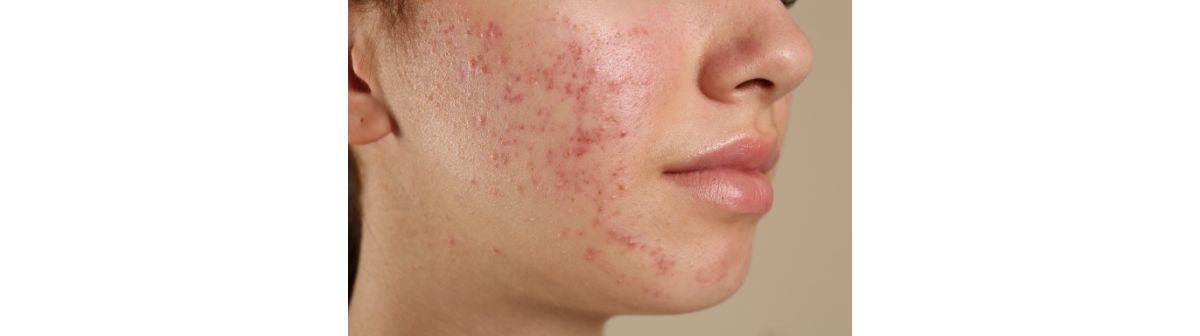 mulher jovem com inflamações de acne conglobata no rosto