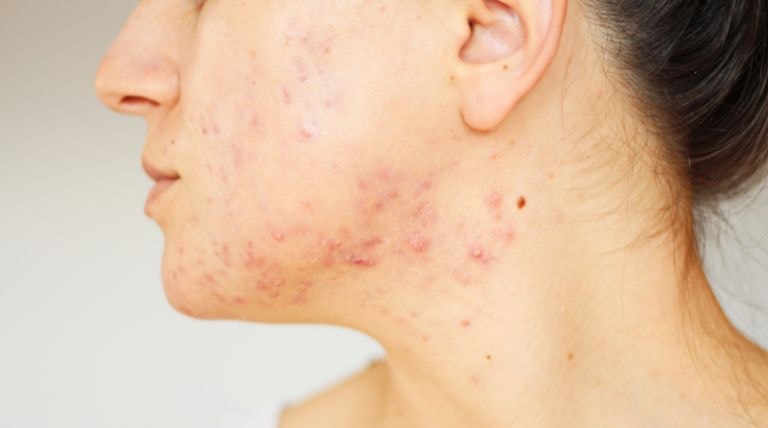 rosto com inflamação de acne conglobata