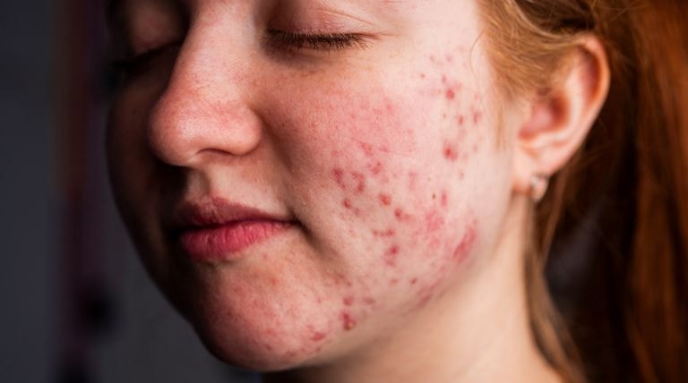 Rosto de jovem com inflamações de acne conglobata no rosto