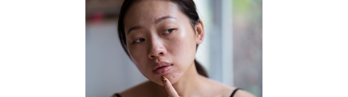 Mulher apontando para acne fúngica 