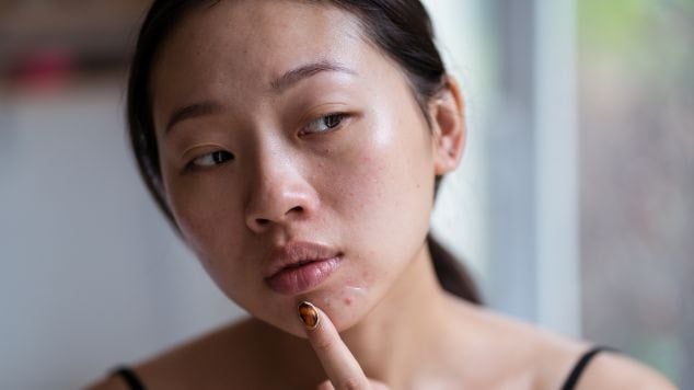 Mulher apontando para acne fúngica
