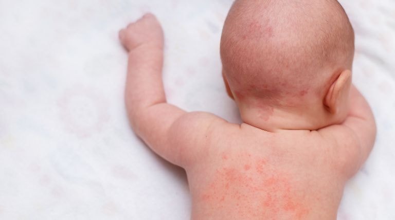 Bolinhas de miliária na pele de uma criança