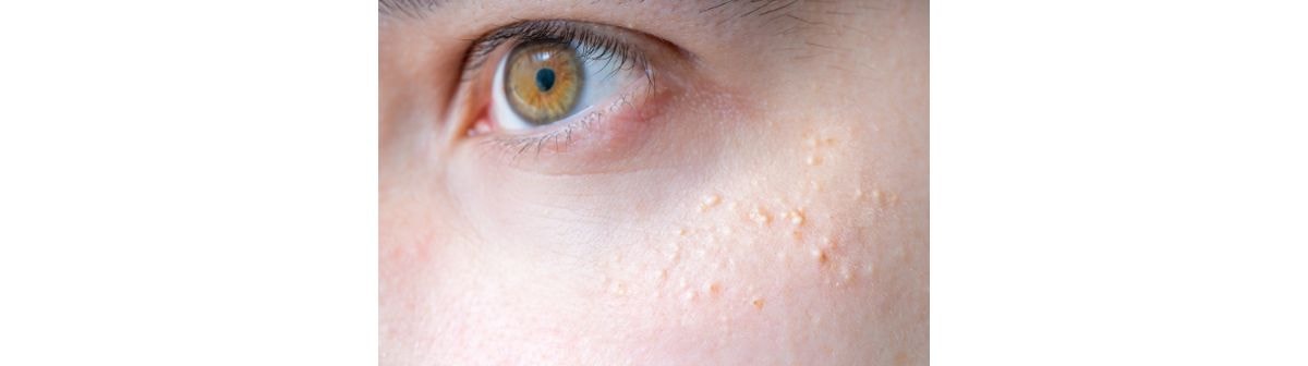 Bolinhas na pele do rosto que podem ser milium, causadas pelo acúmulo de queratina na pele