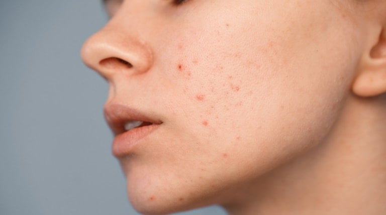 Rosto de jovem que utilizou produtos comedogênicos e desenvolveu acne no rosto