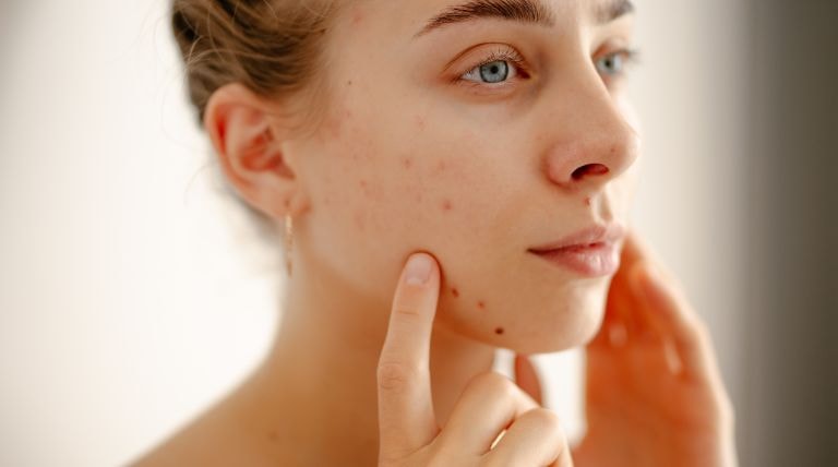 Jovem analisa sua pele com acne para usar ingredientes ativos para espinhas