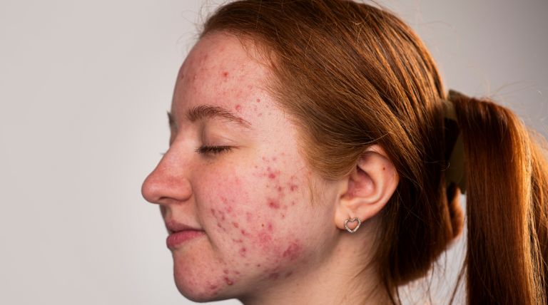 Jovem com acne no rosto se questiona como tirar espinhas do rosto em um dia