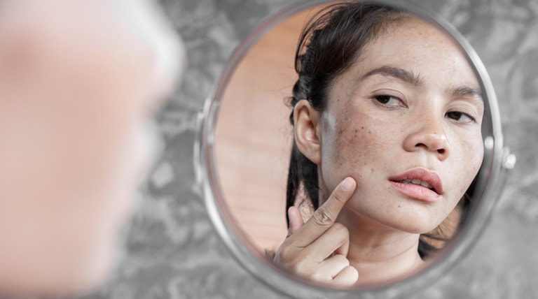 Jovem mulher asiática observa sua pele com manchas e se questiona como tirar mancha de espinha