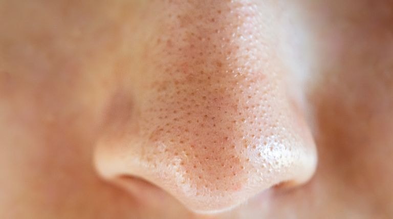 Como tirar cravinhos do nariz e filamentos sebáceos