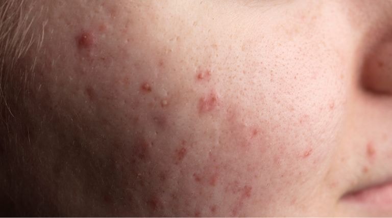 Pele do rosto de jovem com cravos e espinhas