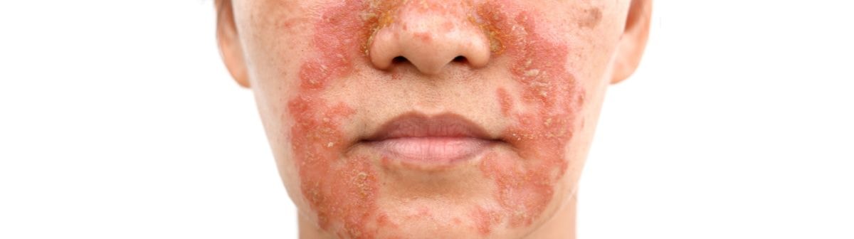 Dermatite seborreica em rosto adulto