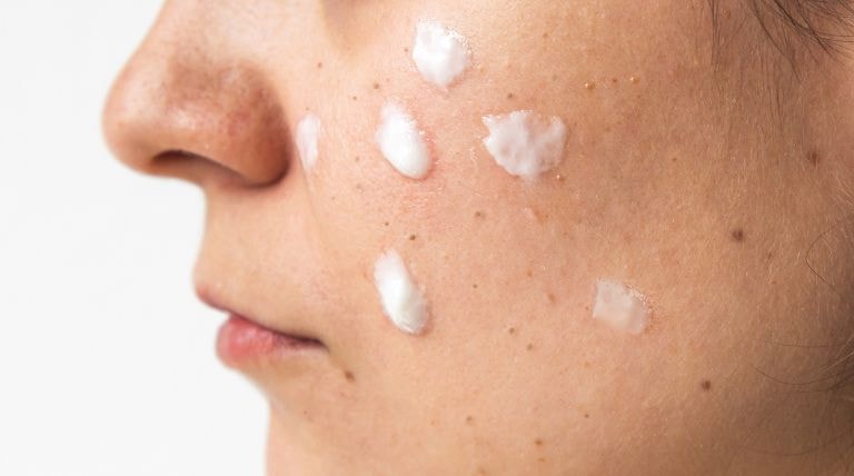 Rosto de uma mulher com a pele acneica e creme emoliente para cravos
