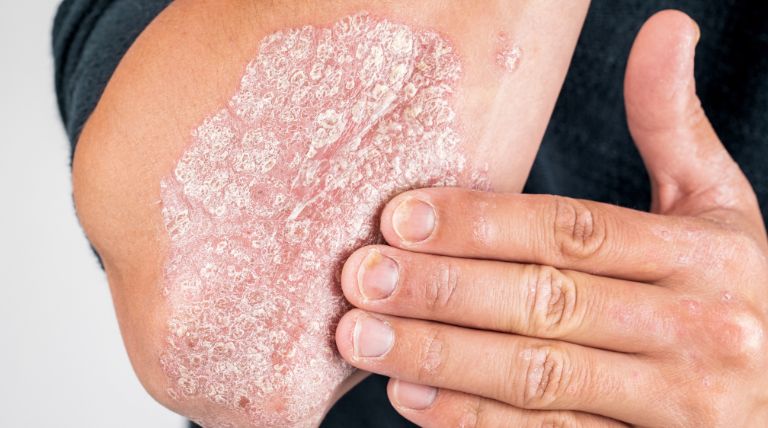 Braço de um homem com ressecamento excessivo sendo tratado com emoliente específico