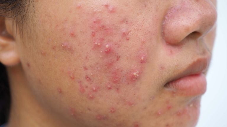 Jovem asiática com acne inflamada no rosto