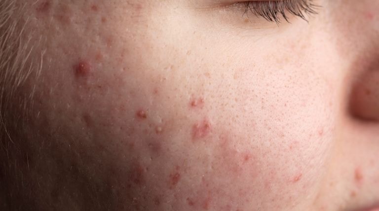 Jovem com manchas de acne e espinha inflamada no rosto
