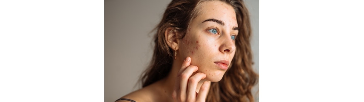 Jovem caucasiana apresenta um quadro de espinhas na bochecha