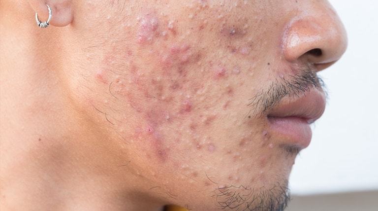 Rosto de um jovem com espinha na bochecha