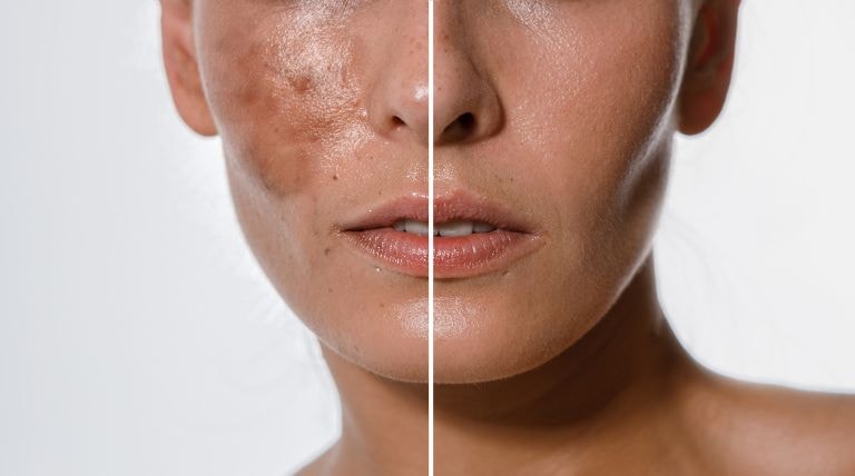 mulher com metade do rosto com hiperpigmentação e a outra metade do rosto com a pele tratada e sedosa.