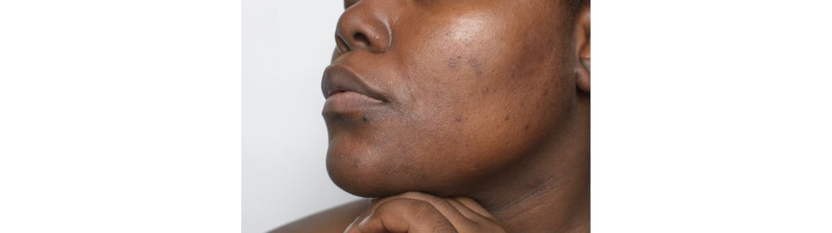 foco em rosto de mulher negra com pontos de hiperpigmentação