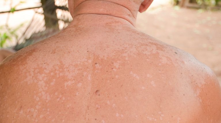 As costas de um homem com manchas brancas de pano branco