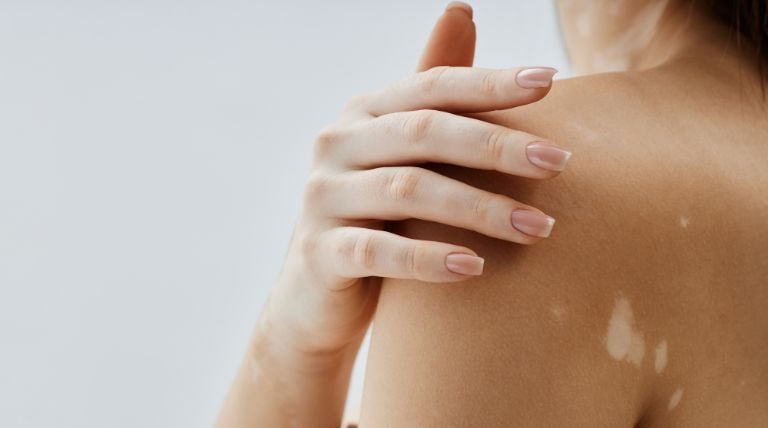 Jovem com manchas brancas de vitiligo na pele 