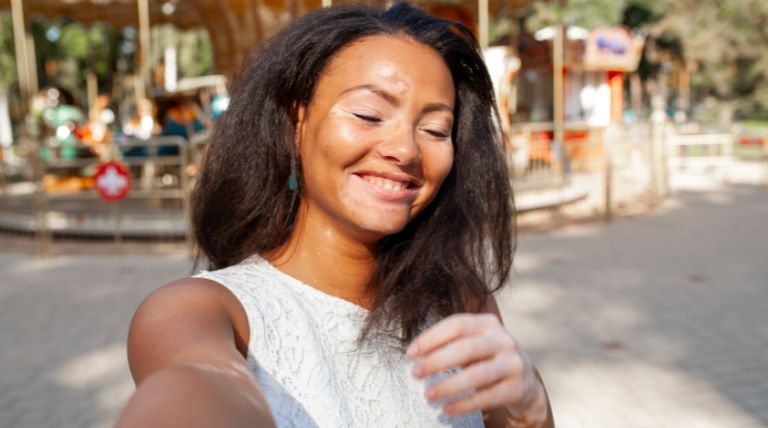 Mulher feliz com manchas brancas de vitiligo na pele
