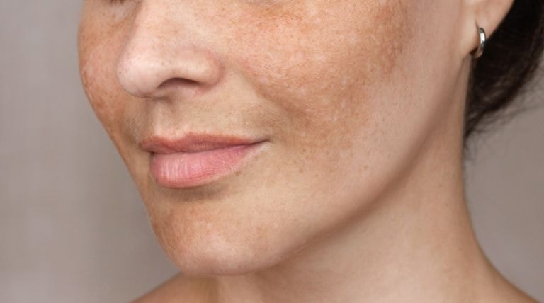 Parte inferior do rosto de uma mulher com manchas de idade