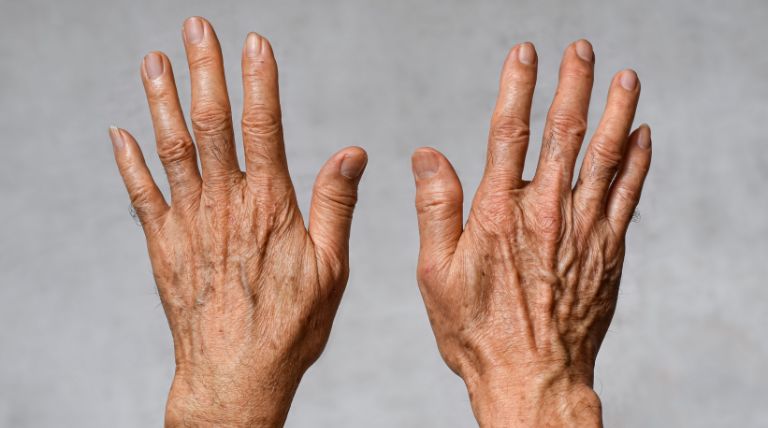 Foto das mãos de uma senhora idosa com a pele envelhecida e manchas de sol ou lentigos solares