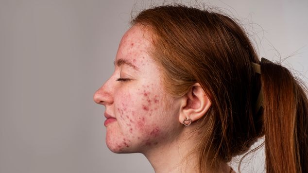 Jovem com acne se questiona o que é bom para espinha e mancha de espinha no rosto