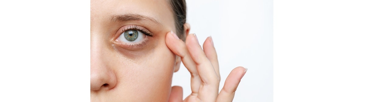 Mulher caucasiana apresenta um quadro de olheira embaixo dos olhos