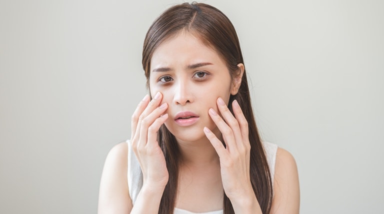 Mulher apresenta um dos tipos de olheiras em seu rosto