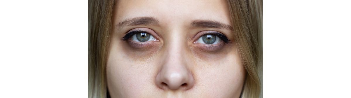 Olhos de uma jovem com olheiras escuras