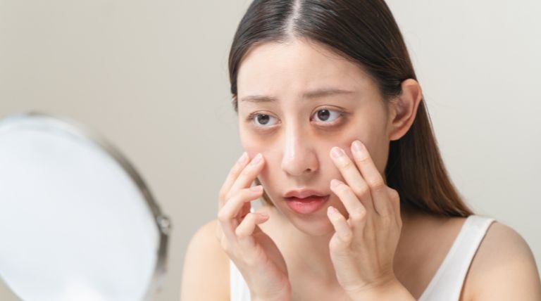 Jovem analisando seu tipo de olheira para saber qual o melhor tratamento para olheiras escuras