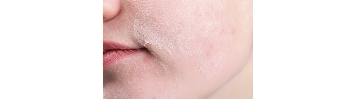 Parte inferior de um rosto com a pele ressecada e seca