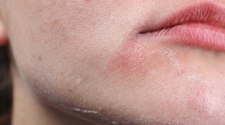 Rosto de jovem com a pele ressecada e seca