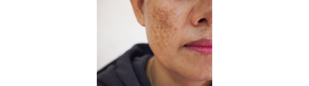 Foto de manchas na pele da parte inferior do rosto de uma mulher