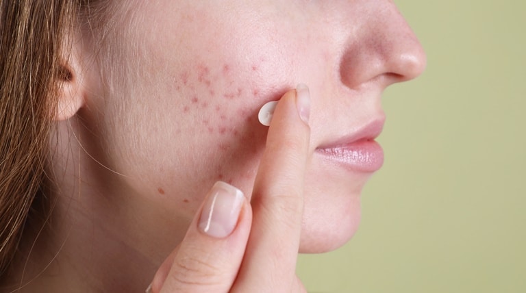 Jovem aplica creme antiacne para manter a pele macia, hidratada e livre das espinhas