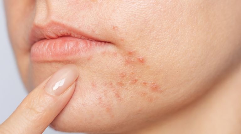 Parte inferior do rosto de uma jovem com a pele acneica que necessita da hidratação facial