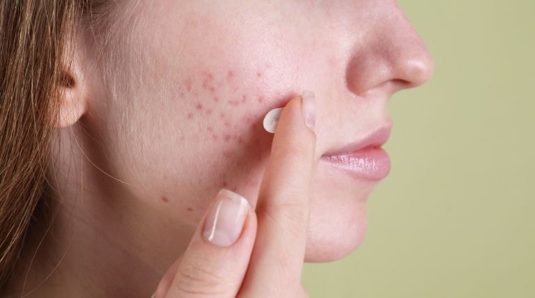 Garota com a pele acneica usa um creme hidratante para pele com acne