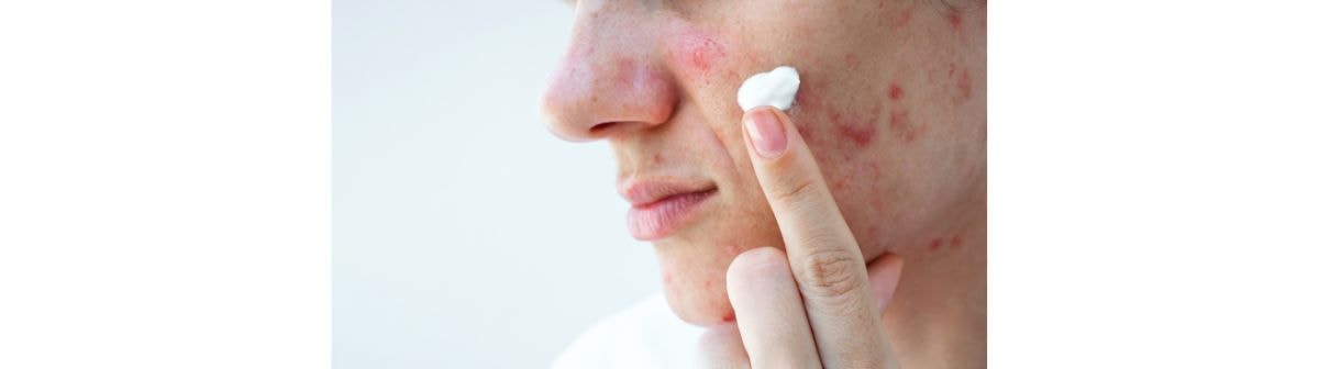 Mulher aplicando o creme para espinha em sua pele facial acneica