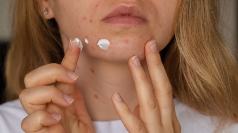 Jovem mulher branca aplicando o creme para espinhas e cravos no rosto
