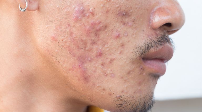  Lado direito do rosto de um jovem com a pele acneica. 