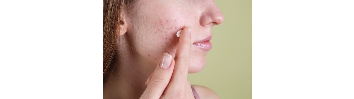 Jovem escolhe entre os melhores hidratantes para pele oleosa e acneica para usar em sua pele facial oleosa e acneica