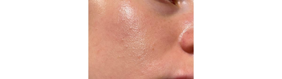 foco em pele facial com poros dilatados e oleosidade na bochecha e nariz que pode usar um primer para pele oleosa