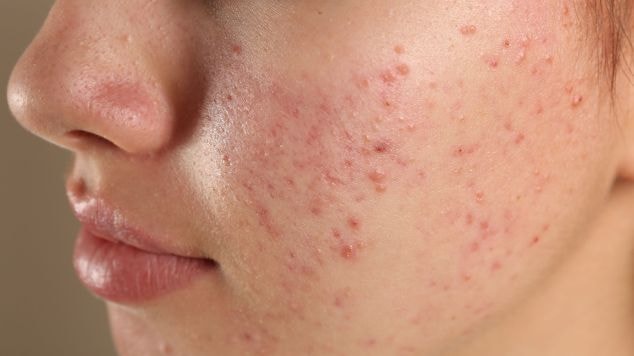 Jovem com acne, cravos e espinhas na pele facial oleosa considera de utilizar outros ativos adequados ao invés do ácido acetilsalicílico na pele.