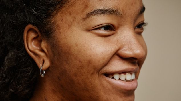 Foto do rosto de uma jovem sorridente com manchas escuras na pele que podem ser tratadas com ácido azelaico.