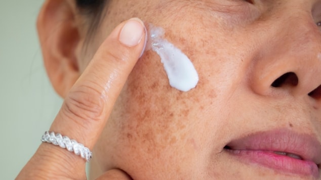 Mulher com manchas na pele do rosto aplica um creme clareador facial