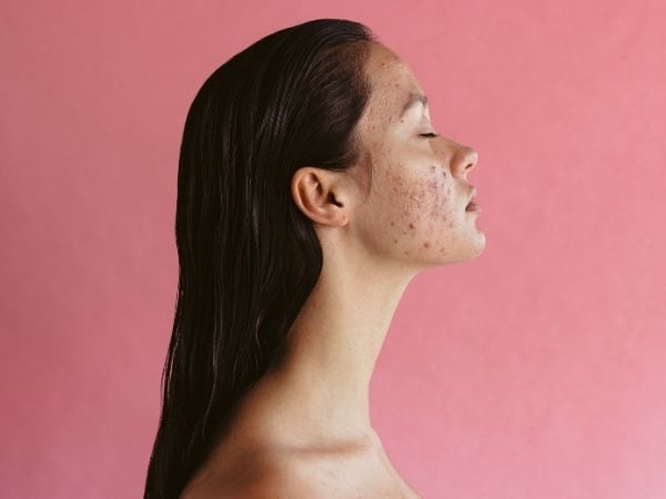 Mulher com acne no rosto, posicionada de perfil com os cabelos todos para trás em um fundo rosa.