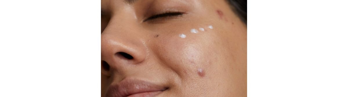 Rosto de uma mulher com tretinoína aplicada na pele para reduzir acne, cravos e espinhas