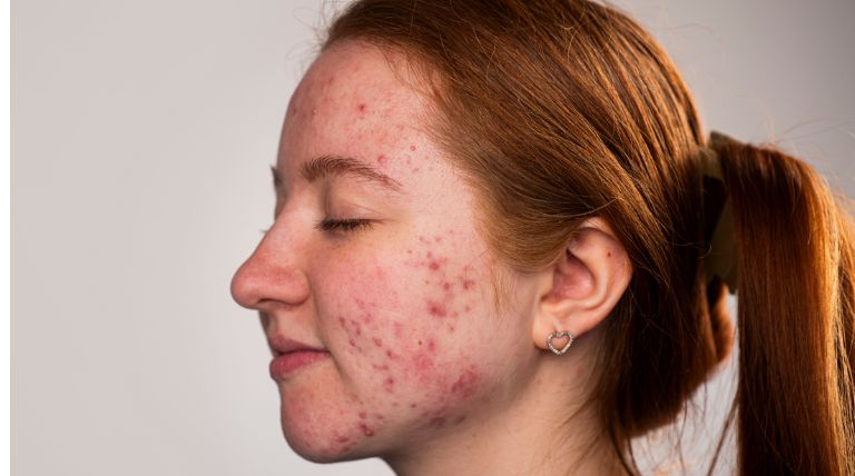 Jovem com diversas espinhas no rosto em tratamento com isotretinoína
